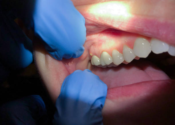 Best Emergency Wisdom Tooth Extraction in Teviston, CA